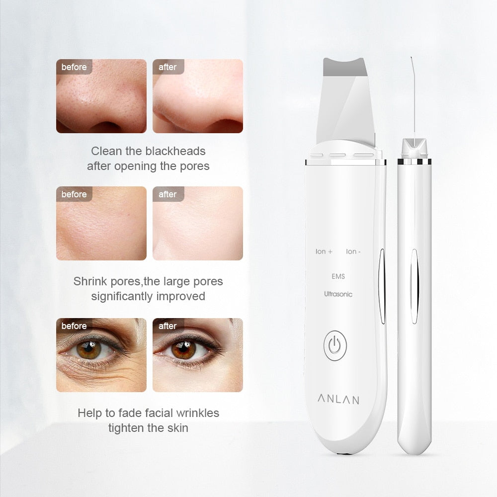 FacialScrubby- Ultrasonic Skin Scrubber Deep Face Cleaning Machine